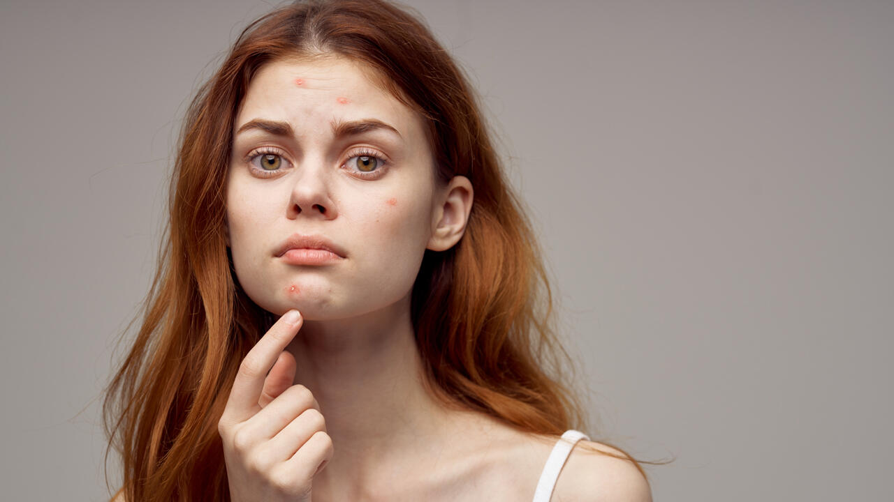 Kosmetik-Allergie: Manche Haut reagiert mit Bildung von Pickeln, andere mit flächiger Reizung.
