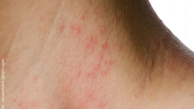 13 Allergiemittel für die Haut im Test 13 Allergiemittel für die Haut im Test