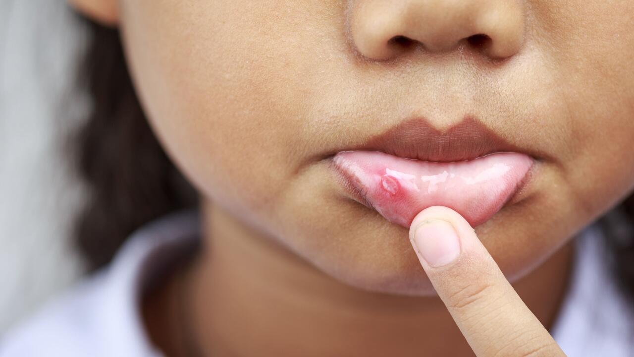 Aphthen im Mund: Was hilft gegen die fiesen Entzündungen?