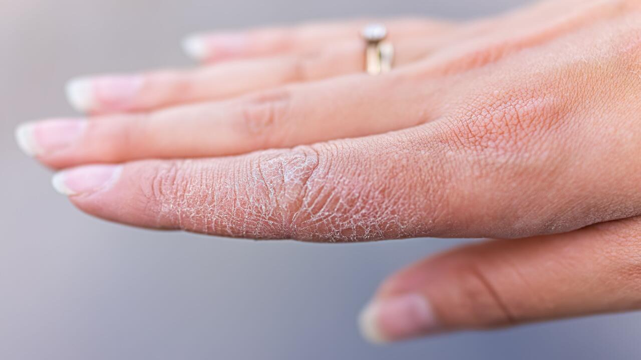 Handpflege ist bei trockenen und rissigen Händen wichtig. 