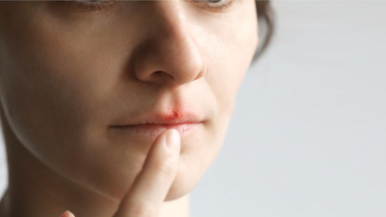 Herpes tritt meist als Bläschen auf den Lippen auf. Helfen Hausmittel dagegen?