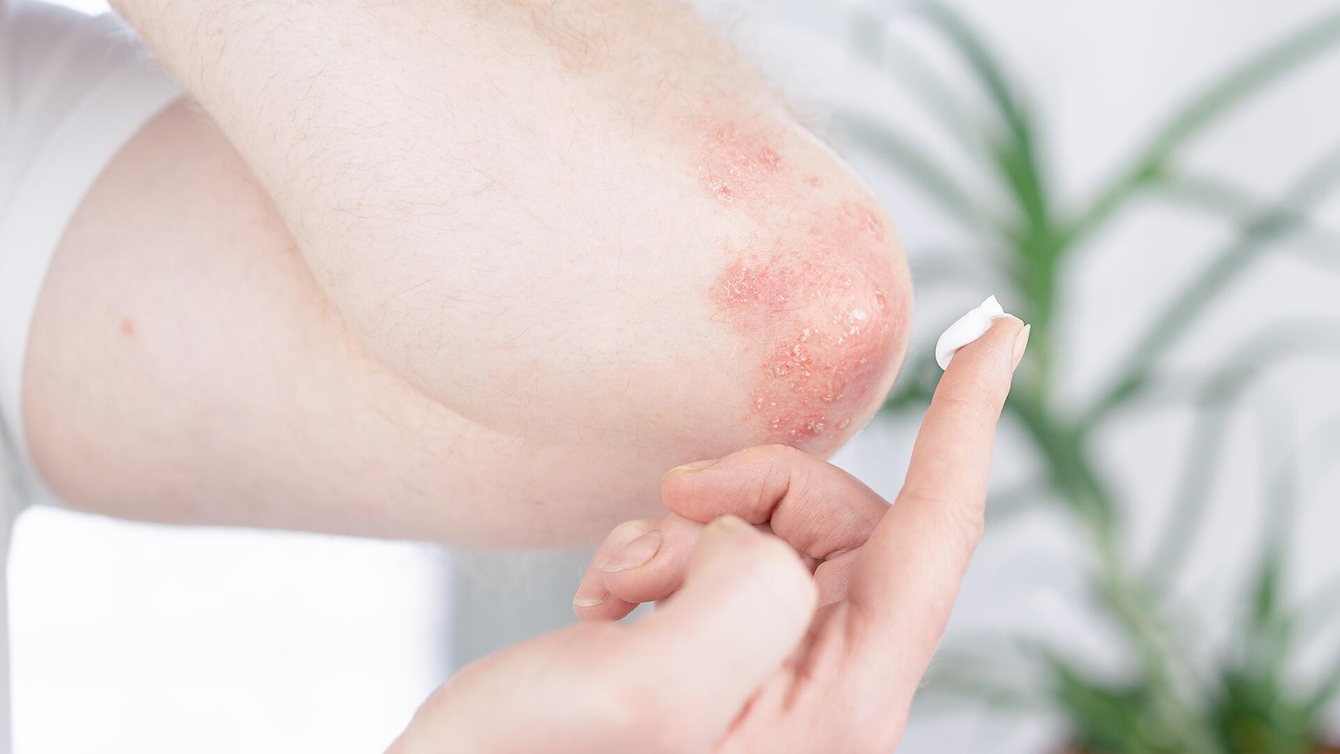 Hydrocortison-Cremes im Test: Wir haben elf Produkte getestet.