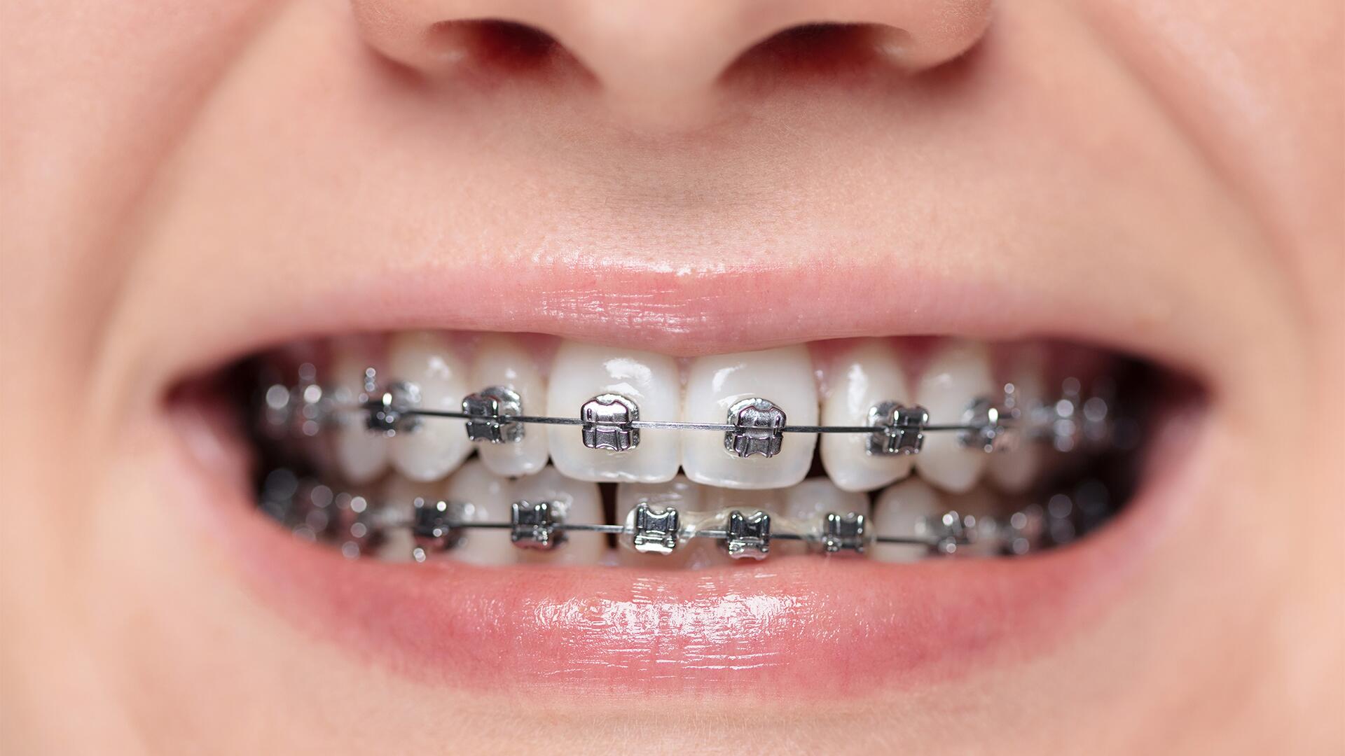 Im Mund vieler Zahnspangenträger stecken Stoffe wie Nickel oder Latex, die Allergiker vermeiden sollten.