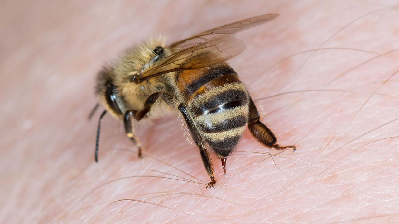 So behandeln Sie einen Bienenstich richtig