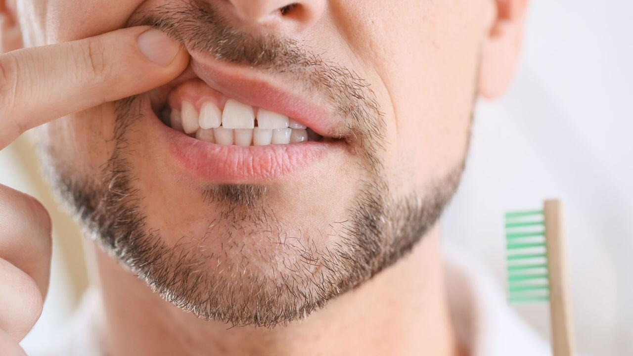 Zahnfleischentzündung: Diese Hausmittel helfen gegen entzündetes Zahnfleisch