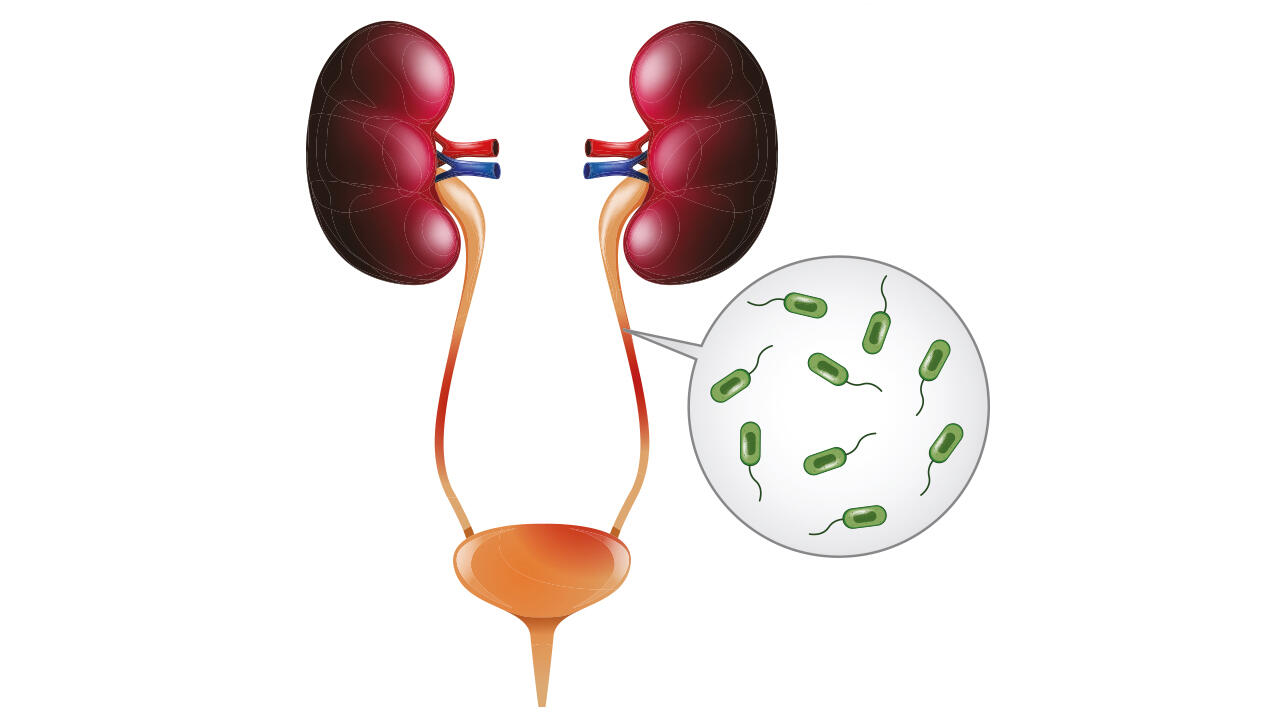 Bei einer Blasenentzündung wird die Harnröhre bis hin zur Blase von Bakterien besiedelt, die die Entzündung auslösen. Nur wenige freiverkäufliche Mittel gegen Blasenentzündung können wirklich helfen.