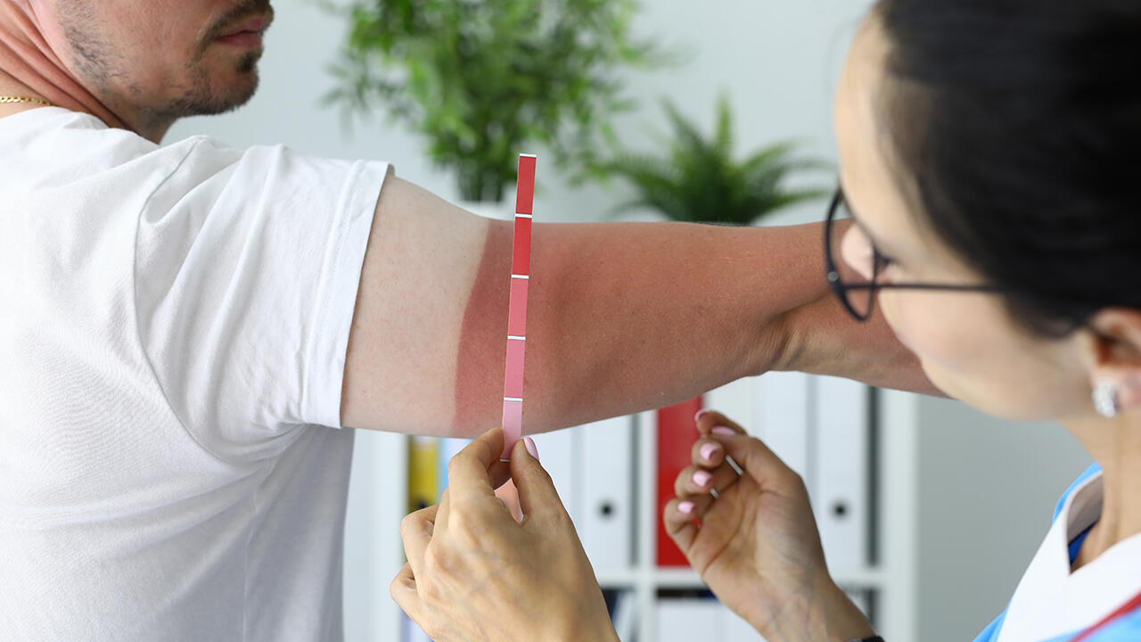 In schwerwiegenden Fällen sollten Sie bei Sonnenbrand einen Arzt aufsuchen. In schwerwiegenden Fällen sollten Sie bei Sonnenbrand einen Arzt aufsuchen.