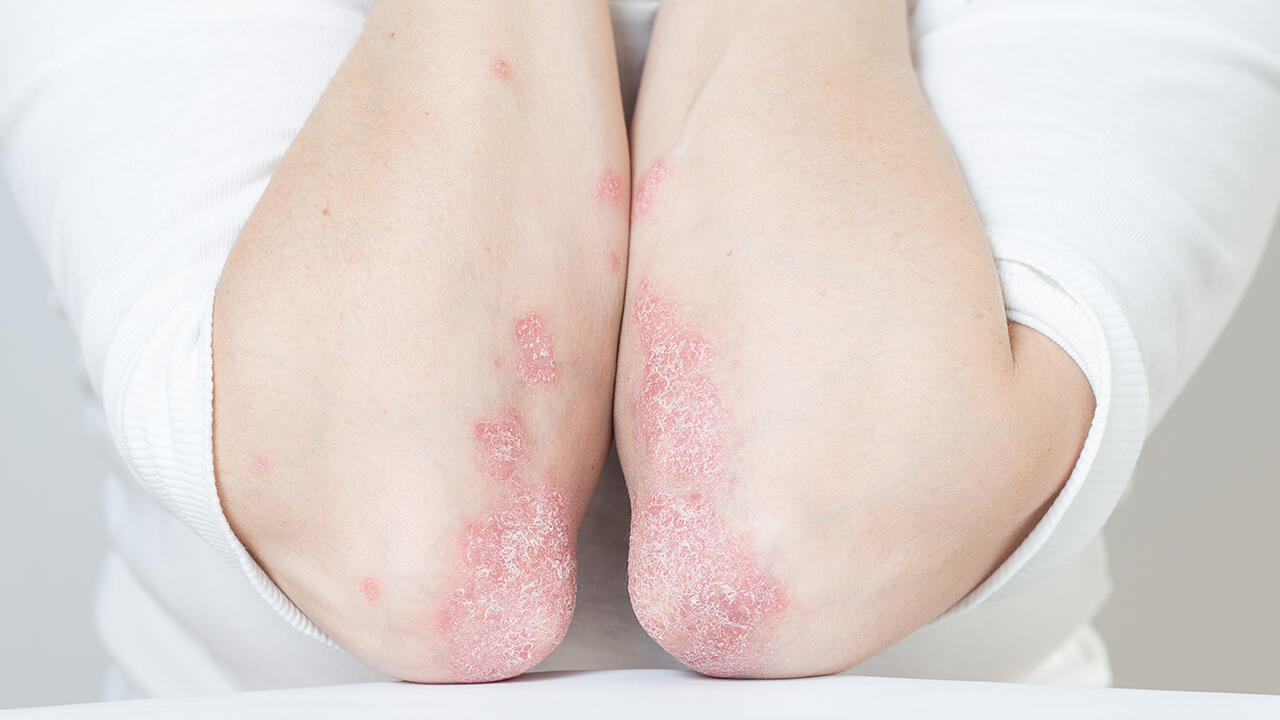 Oft greifen Menschen mit Hautkrankheiten wie Schuppenflechte (Psoriasis) zu Körperlotionen mit Urea. Umso ärgerlicher ist es, wenn die Produkte Stoffe enthalten, die nicht gerade gut für die Haut sind. Oft greifen Menschen mit Hautkrankheiten wie Schuppenflechte (Psoriasis) zu Körperlotionen mit Urea. Umso ärgerlicher ist es, wenn die Produkte Stoffe enthalten, die nicht gerade gut für die Haut sind.