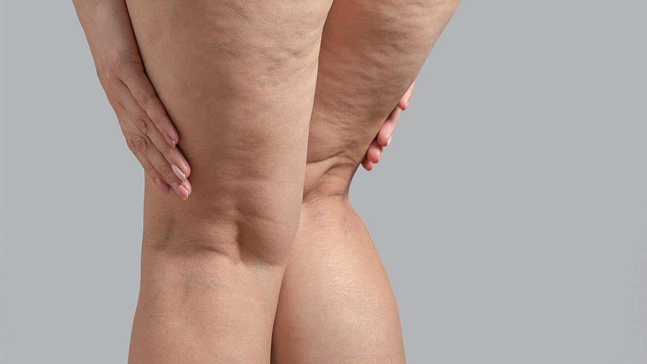 Cellulite entsteht vor allem an Oberschenkeln und Po. Cellulite entsteht vor allem an Oberschenkeln und Po.