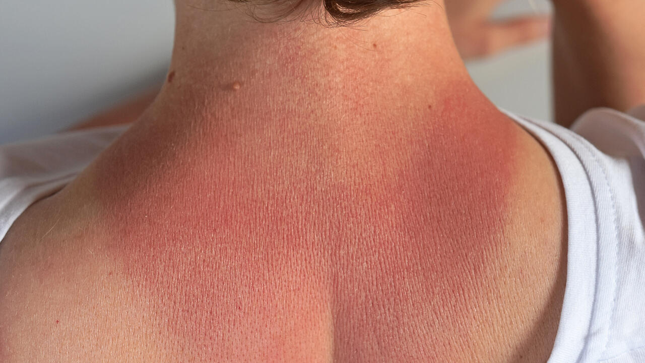 Im Frühling kann man besonders schnell einen Sonnenbrand bekommen. Im Frühling kann man besonders schnell einen Sonnenbrand bekommen.