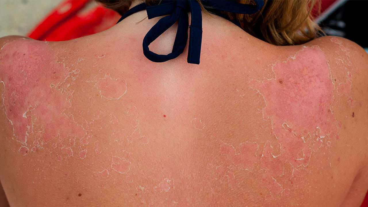 Sonnenbrand kann sehr unangenehm sein – und zu Hautkrebs führen.