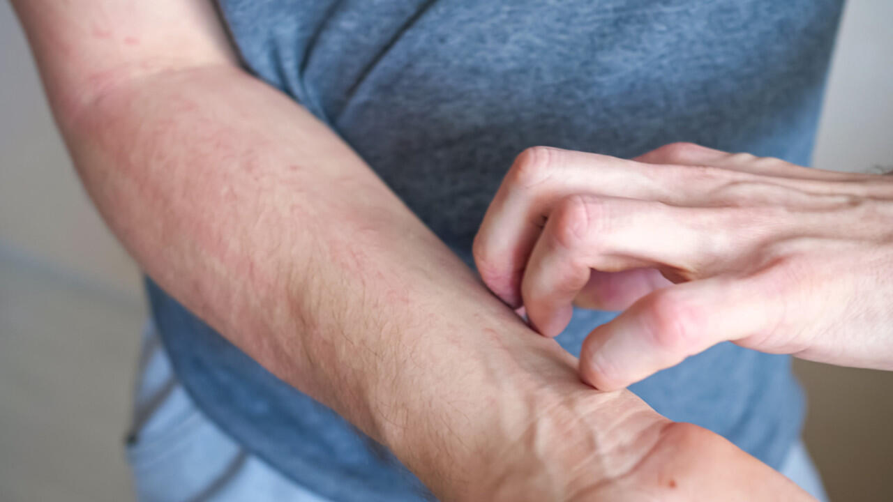 Auch wenn die Haut nach Grasmilben-Bissen stark juckt, sollten Sie nicht kratzen. Auch wenn die Haut nach Grasmilben-Bissen stark juckt, sollten Sie nicht kratzen.