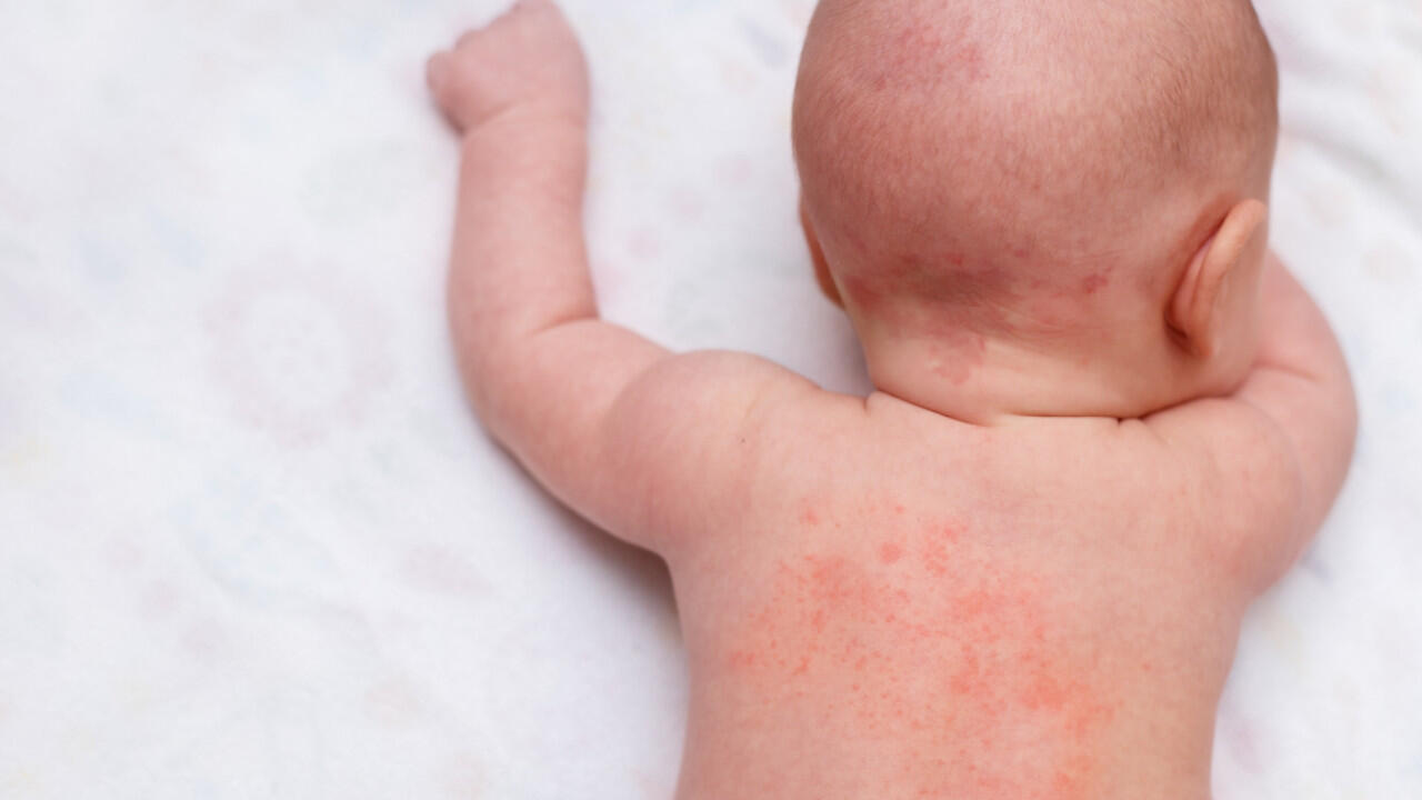 Babys sind anfällig für Hitzepickel, da ihre Schweißdrüsengänge noch nicht vollständig ausgebildet sind. Babys sind anfällig für Hitzepickel, da ihre Schweißdrüsengänge noch nicht vollständig ausgebildet sind.