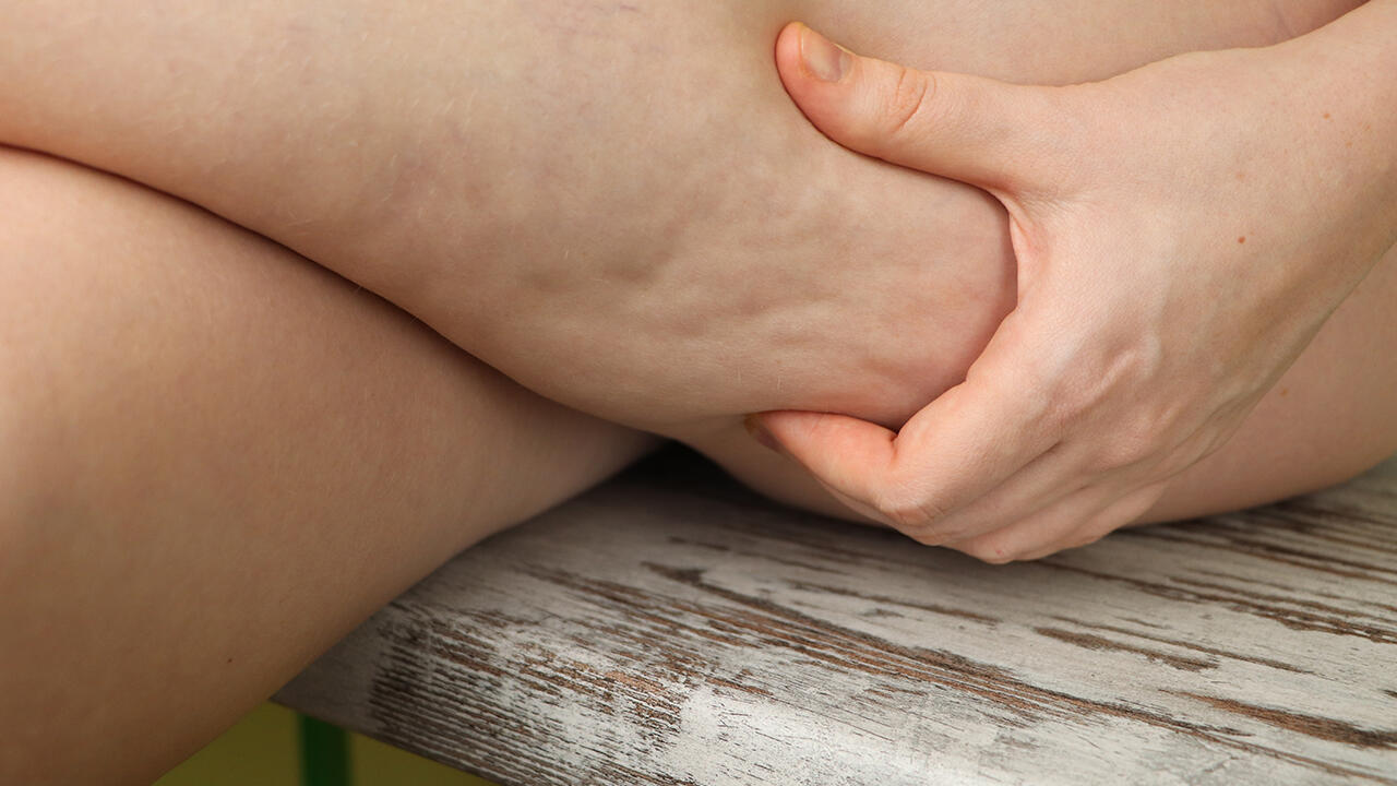 Po und Oberschenkel sind am häufigsten von Cellulite betroffen.