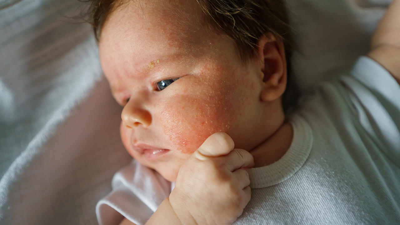 Hat das Baby Neurodermitis, ist das für die Familie oft eine große Herausforderung.