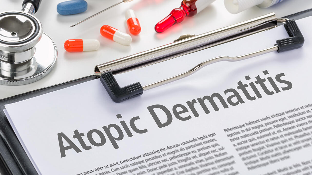 Das Repertoire an medikamentösen Behandlungsmöglichkeiten bei Neurodermitis ist mittlerweile wesentlich größer als früher.