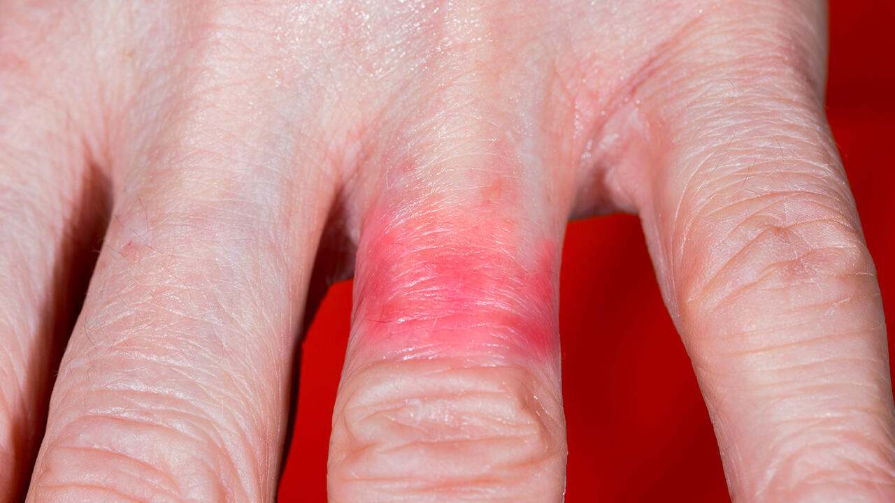 Eine Nickel-Dermatitis ist nicht nur sichbar, die Folgen können auch sehr schmerzhaft sein.