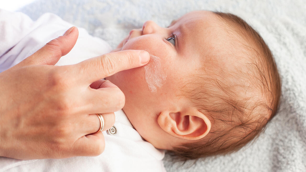 Neurodermitis im Gesicht: Die Hautkrankheit kann sehr unangenehm sein. Neurodermitis im Gesicht: Die Hautkrankheit kann sehr unangenehm sein.