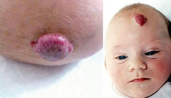 Babyhaut Milchschorf Kopfgneis Neurodermitis Co Oko Test