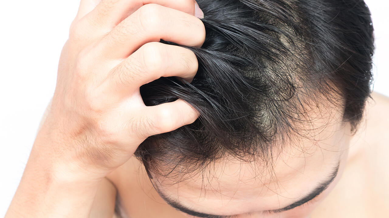 Juckreiz ist ein bekanntes Symptom für schuppige Kopfhaut. Juckreiz ist ein bekanntes Symptom für schuppige Kopfhaut.