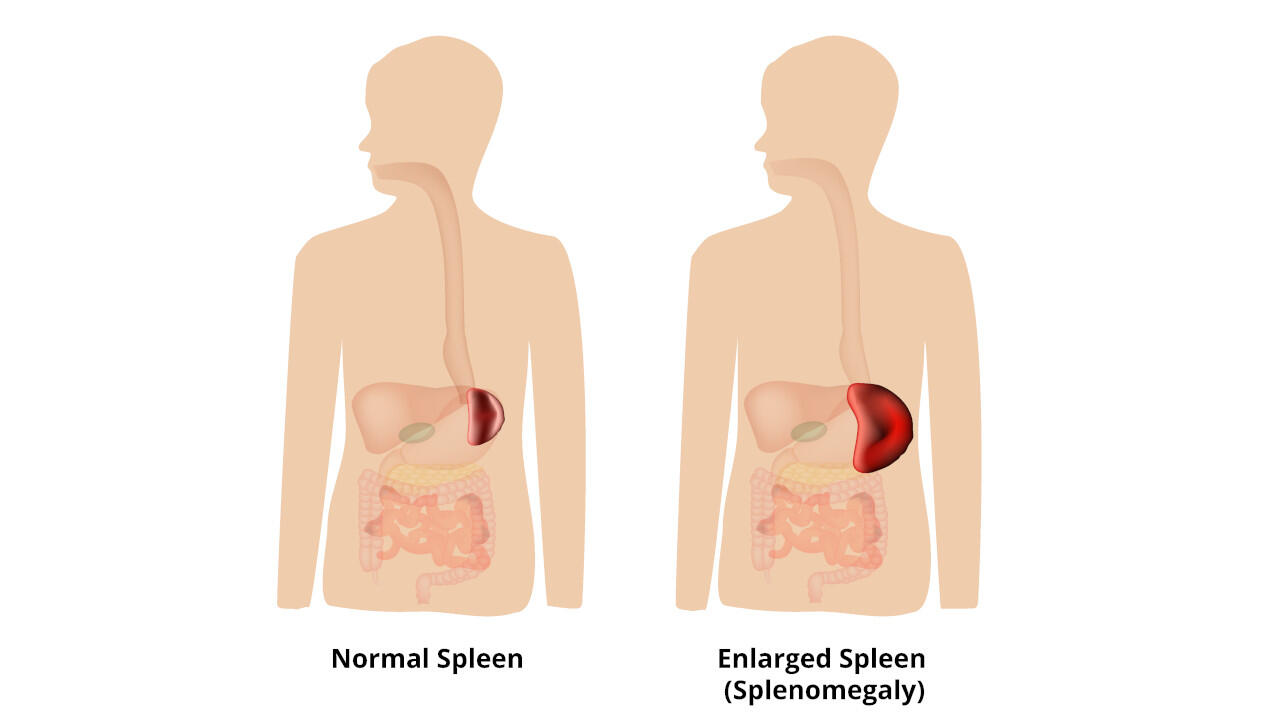 Eine vergrößerte Milz bedeutet eine verstärkte Abwehrarbeit der Milz.