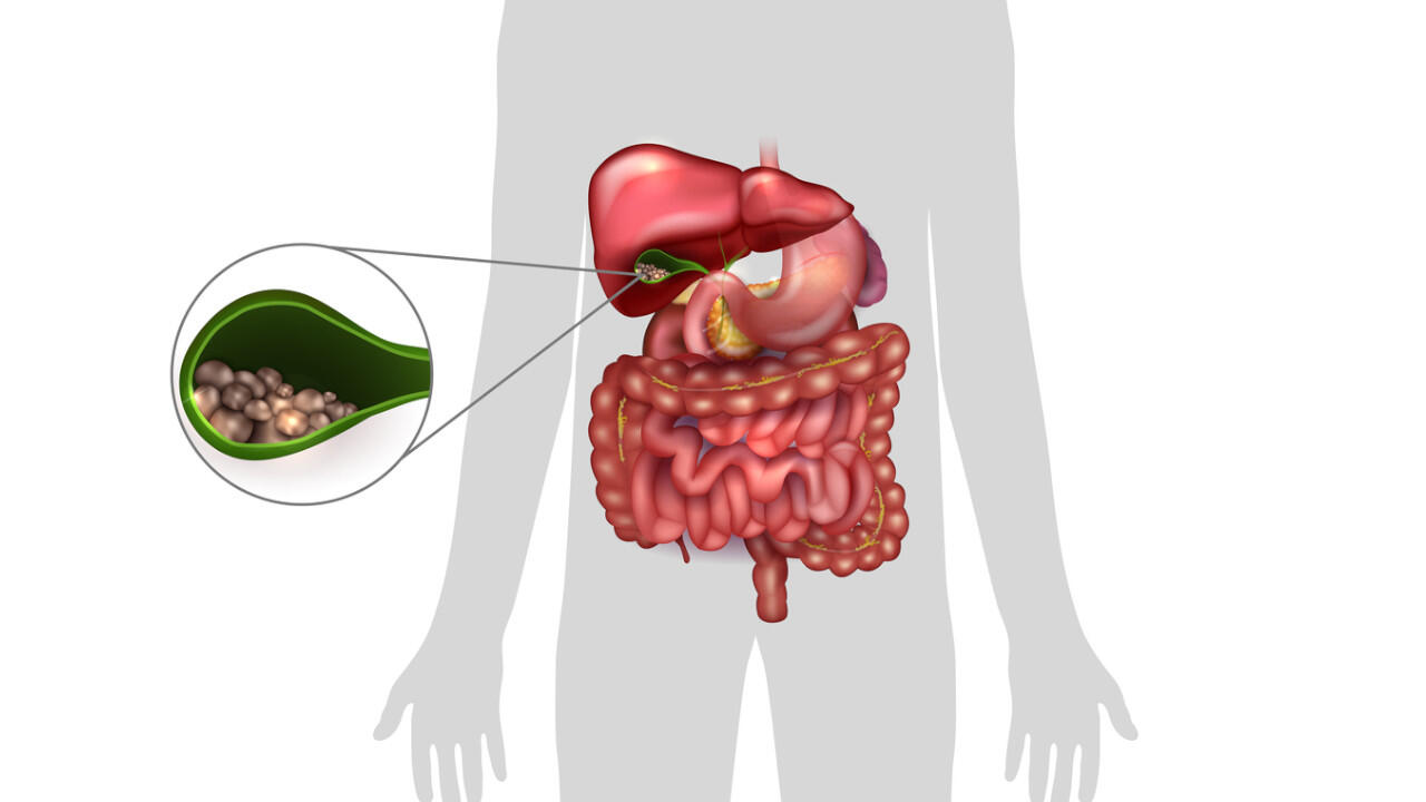 In der Gallenblase können sich durch verfestigte Gallenflüssigkeit Gallensteine entwickeln.