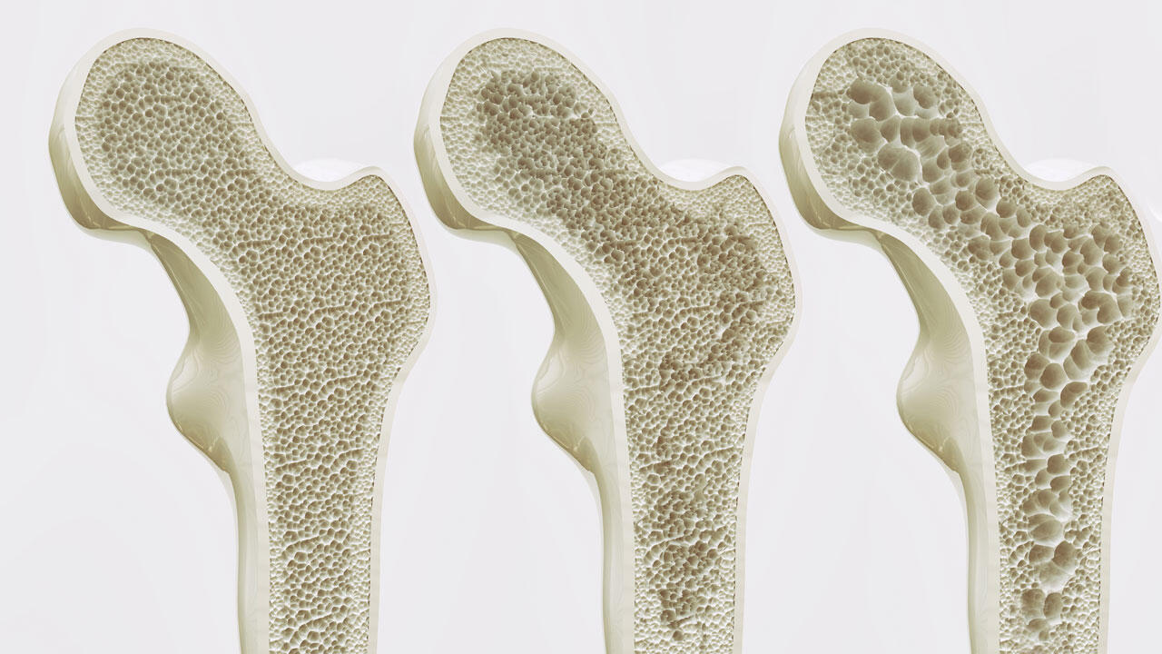 Bei Osteoporose (Knochenschwund) wird Knochensubstanz abgebaut. 