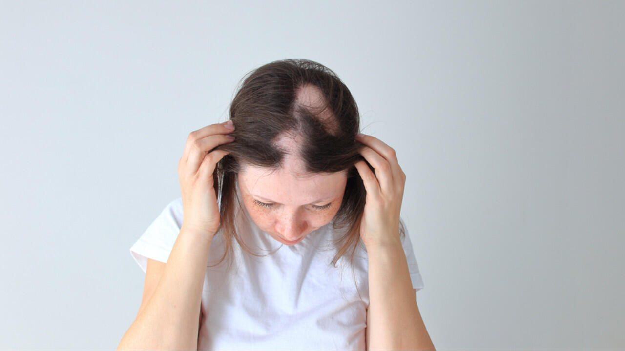 Bei kreisrundem Haarausfall fällt das Haar stellenweise aus. Bei kreisrundem Haarausfall fällt das Haar stellenweise aus.