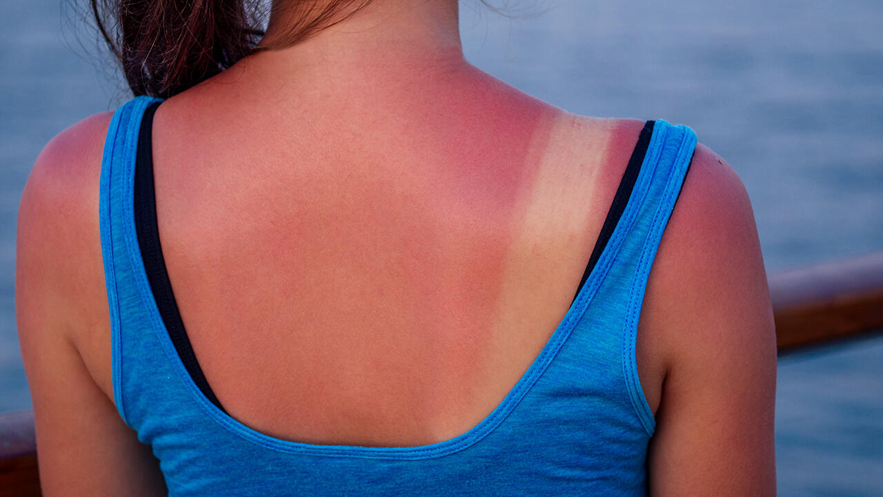 Ein Sonnenbrand kann die Urlaubslaune schnell verderben. After-Sun-Produkte versprechen erste Hilfe, reparieren aber keine Hautschäden.