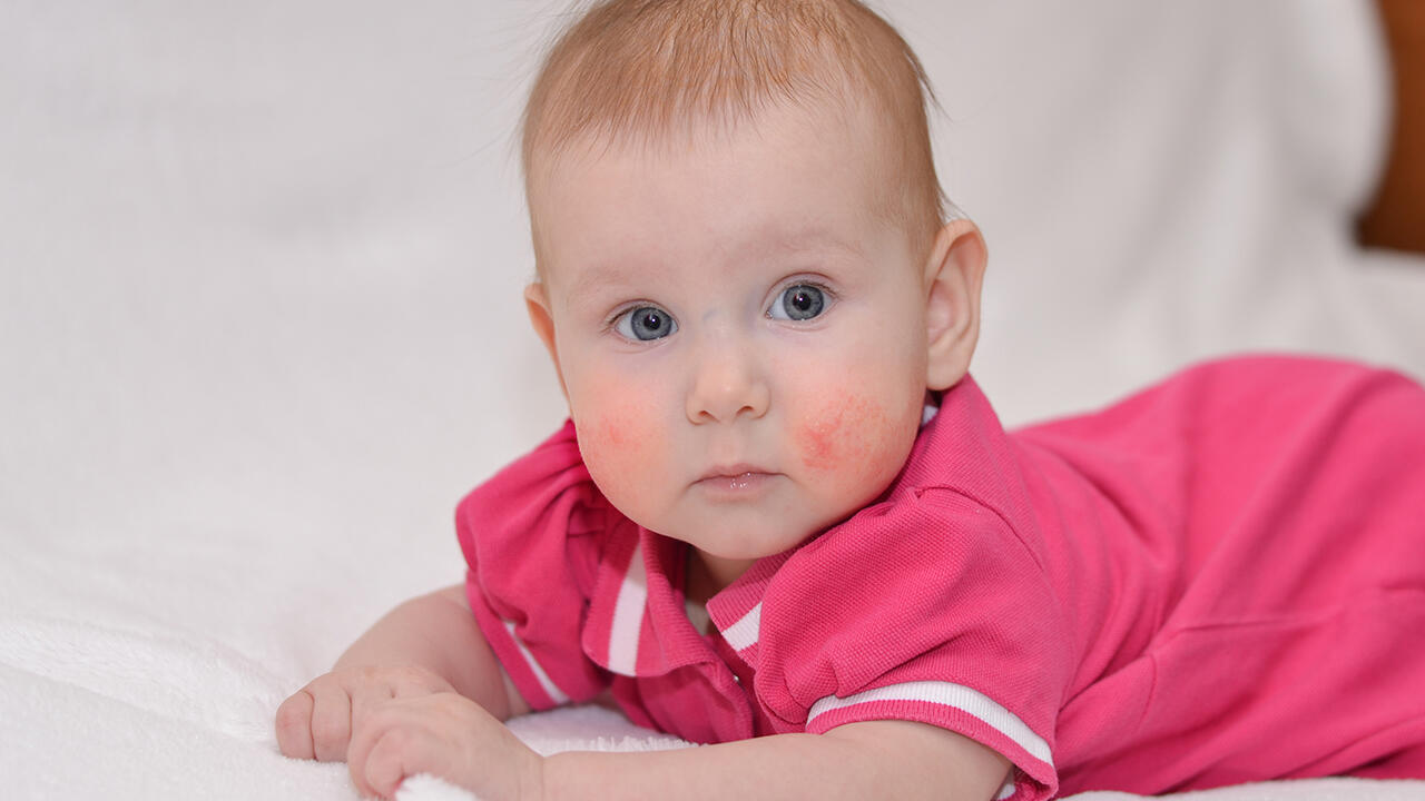 Auch viele Kinder leiden unter gereizter Haut oder Neurodermitis. Eltern sind dann auf der Suche nach einer schonenden Hautpflege. Auch viele Kinder leiden unter gereizter Haut oder Neurodermitis. Eltern sind dann auf der Suche nach einer schonenden Hautpflege.