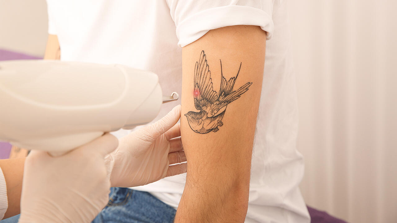 Tattoos dürfen seit 2021 nur noch von Ärzten entfernt werden, die über Fachkenntnisse im Umgang mit Lasergeräten verfügen. 