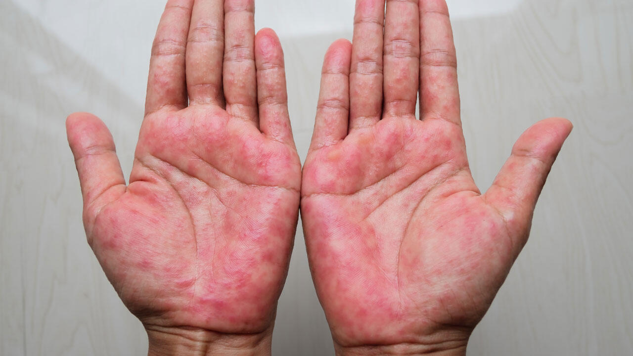 Neurodermitis an den Händen ist für die Betroffenen eine besondere Einschränkung.