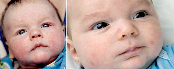 Neugeborenenekzem (links) und Neugeborenenakne (rechts)