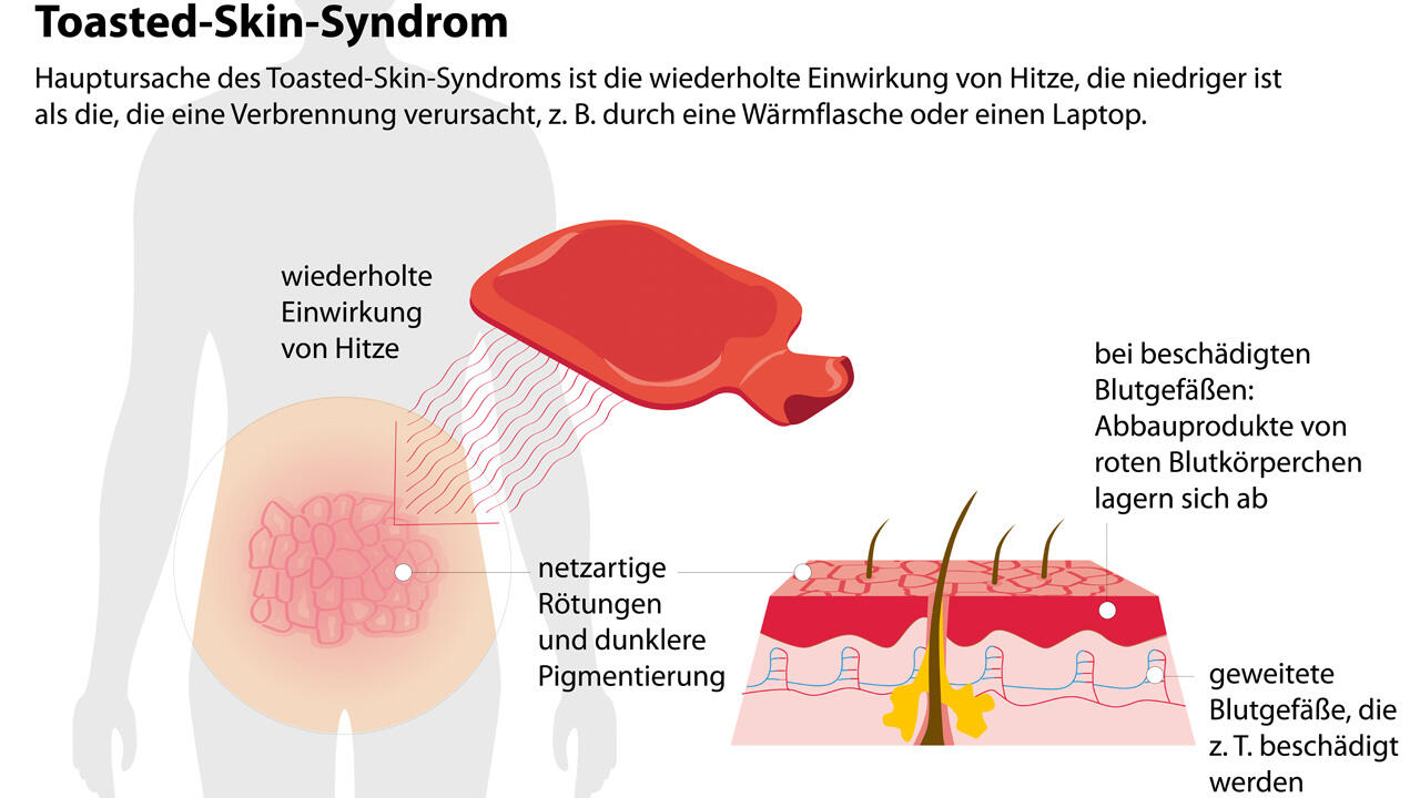 Gitterförmige Verfärbungen der Haut: Wer die an sich beobachtet, ist wahrscheinlich vom Toasted-Skin-Syndrom betroffen.