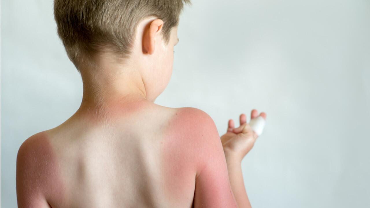Was hilft gegen Sonnenbrand? Sonnenbrand vorbeugen und behandeln
