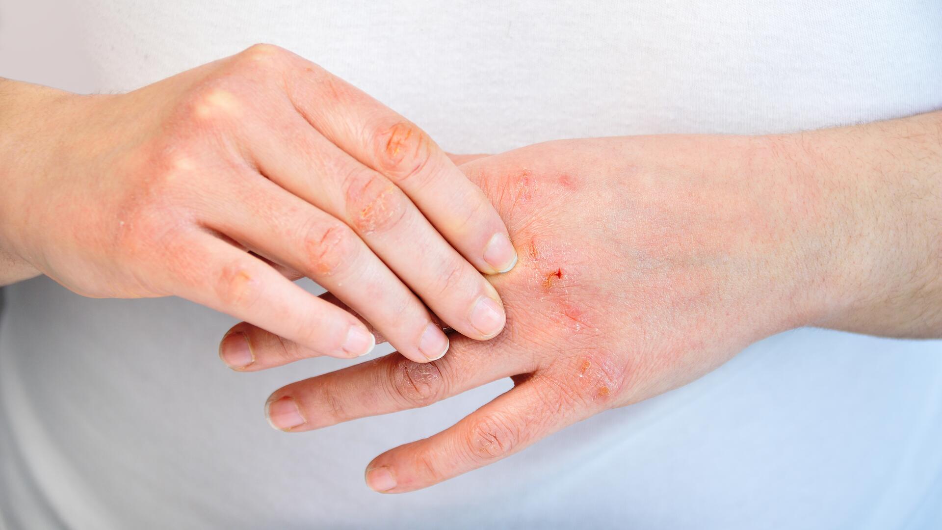 Trockene Hände: Diese 5 Tipps helfen gegen strapazierte Haut