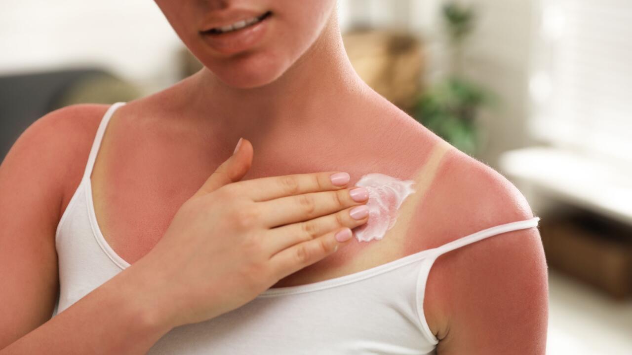 Hausmittel gegen Sonnenbrand: Ein Hautarzt erklärt, was helfen kann